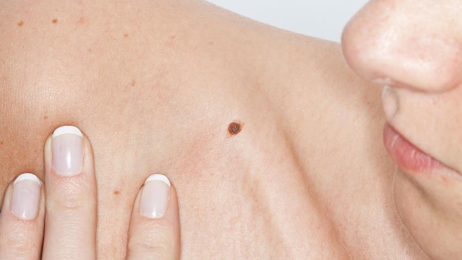 Résultats prometteurs d'un vaccin thérapeutique contre le mélanome