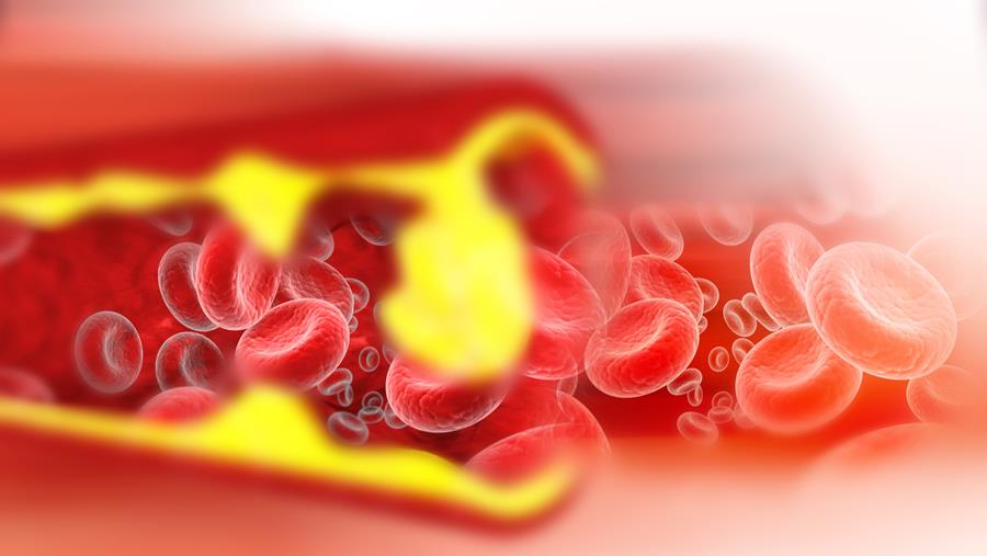 Après une PCI, faut-il prolonger la double antiagrégation jusqu’à deux ans chez les patients pluritronculaires ?