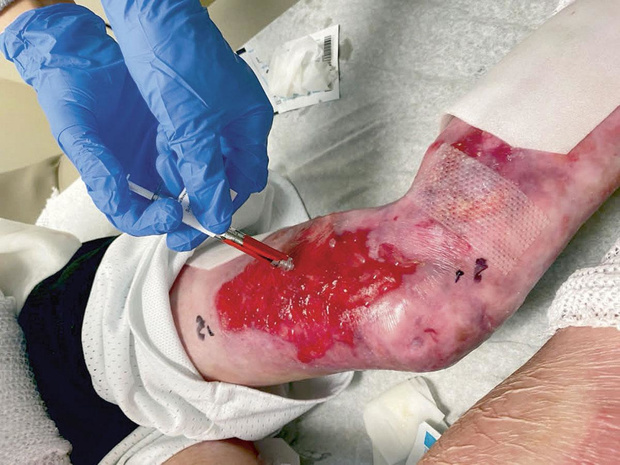 Une thérapie génique sous forme de gel 