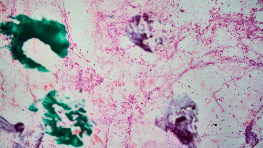 HARMONi-6: ivonescimab, nieuwe eerstelijnstherapie voor gevorderd spinocellulair bronchuscarcinoom