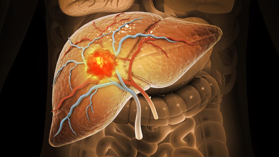 GLP-1-receptoragonisten en preventie hepatocellulair carcinoom: een signaal in het reële leven