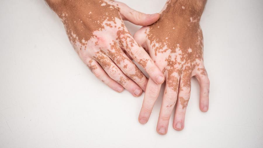 « Il est clair que la prise en charge du vitiligo peut être améliorée »