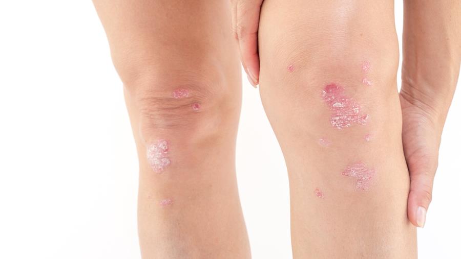 Arthrite psoriasique et surcharge pondérale: nouvelles données en faveur de l’ajout d’un aGLP-1 à un anti-IL-17A