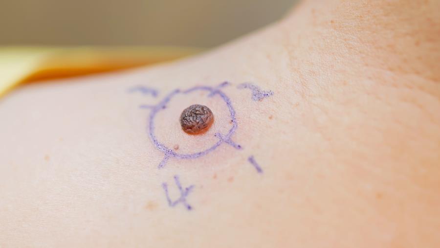 Melanoom: voordeel van nivolumab bevestigd na negen jaar