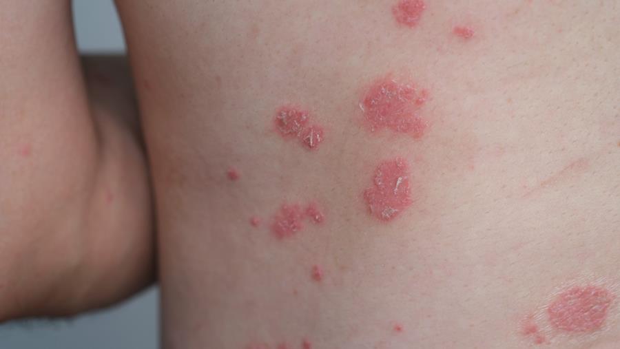Biologicals bij psoriasis: kunnen we IL-17- en IL-23-remmers veilig afbouwen?
