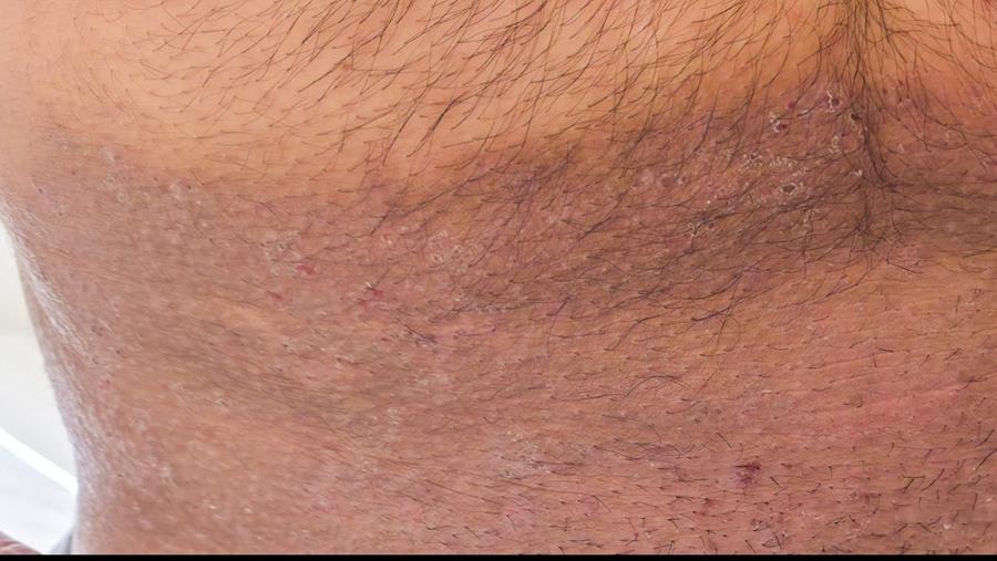 Trichophyton indotineae: opmars van een resistente tinea